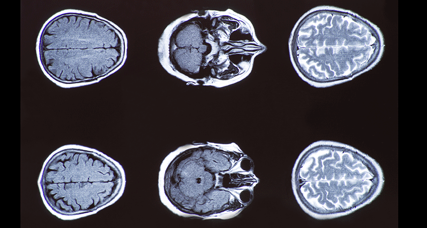 brain cat scan