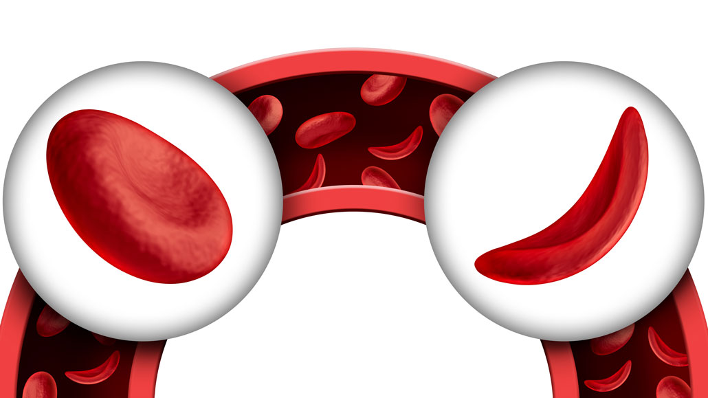 Explainer What Is Sickle Cell Disease 