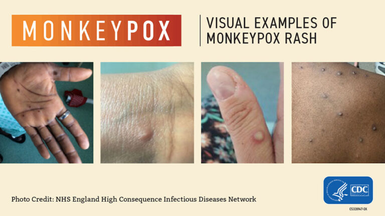 Explainer: What Is Mpox (formerly Monkeypox)?