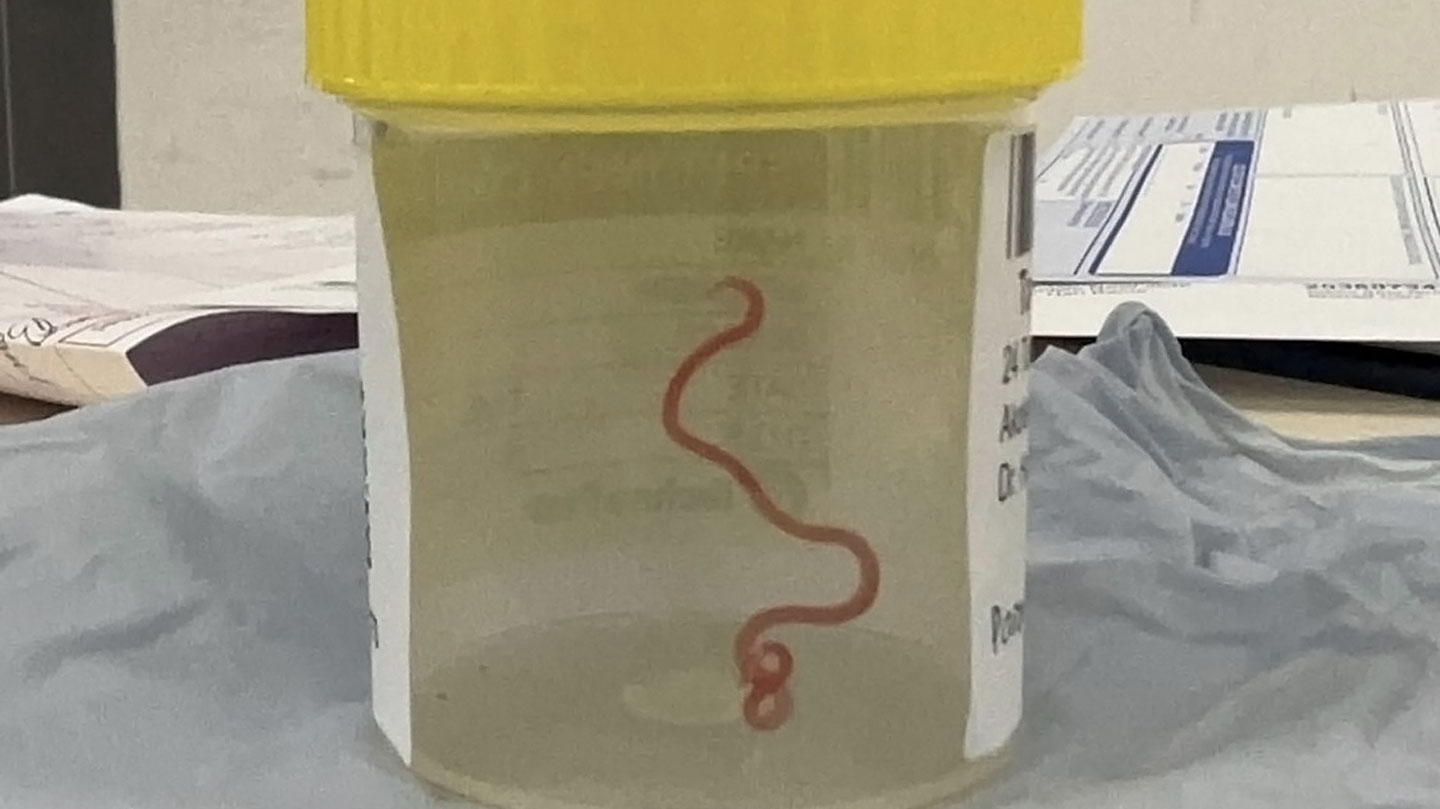 Doctors found a snake parasite in a woman's brain — still alive