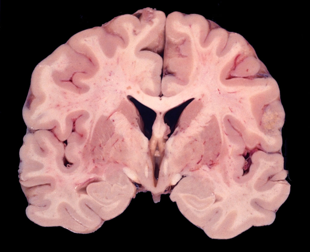 a coronal cross section of a human brain at the level of the hippocampus showing the ventricular system (lateral ventricles and third ventricle) and other brain structures