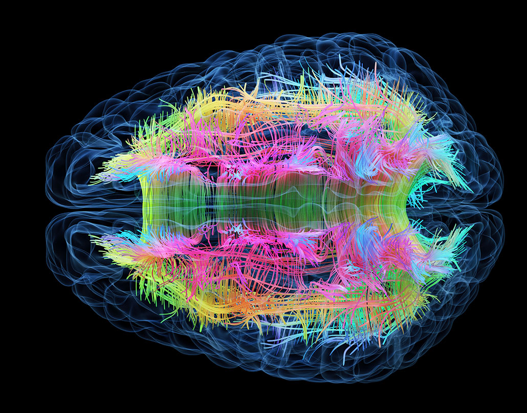 an image of the brain showing the corpus callosumSEBASTIAN KAULITZKI/SCIENCE PHOTO LIBRARY