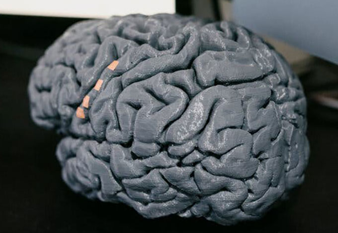 a 3D printed gray brain model of Casey Harrell's brain, showing four orange spots where microelectrodes implants were placed